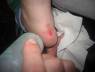 Clasica herida producida por el calzado